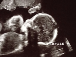 Profile of Baby B