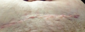 incision 14.5 days after surgery
